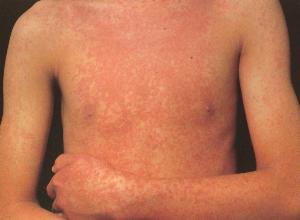 胆碱能性寻麻疹的病因是什么