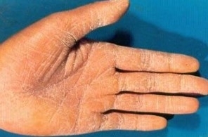 手癣有哪些常见的症状