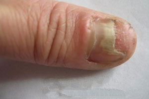 日常预防灰指甲的方法
