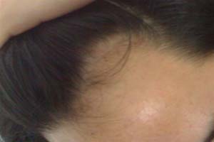 脂溢性脱发有什么症状表现