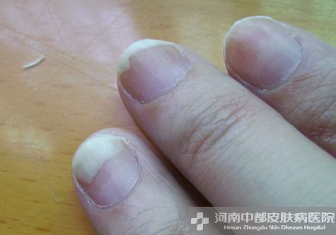 灰指甲治疗方法是什么呢